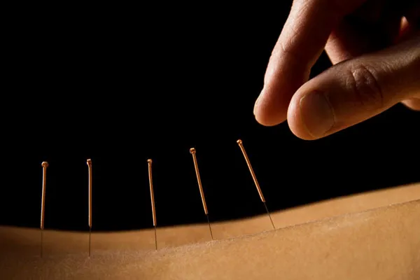 Fine needles placed along a patient's back